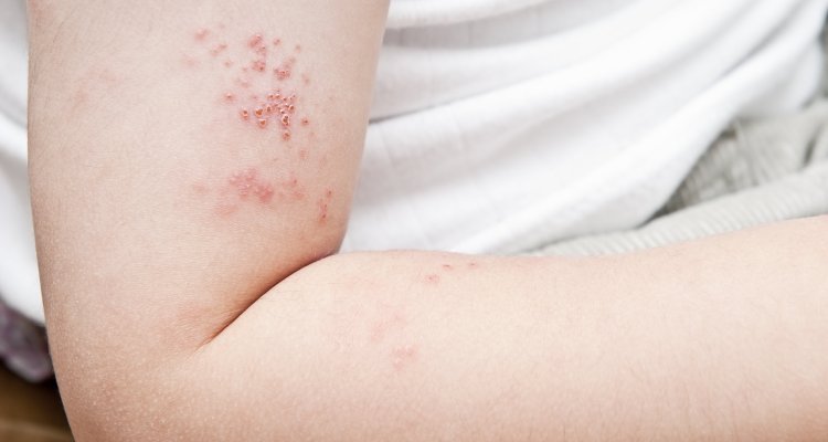 shingles cause and disease